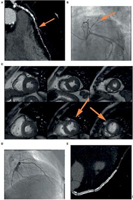 The Role of Multimodality Imaging for Percutaneous Coronary Intervention in Patients With Chronic Total Occlusions